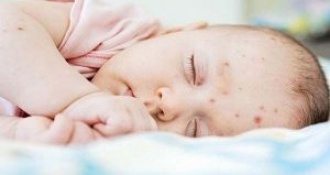 Trẻ sơ sinh bị nóng trong người phải làm sao? Cách khắc phục 